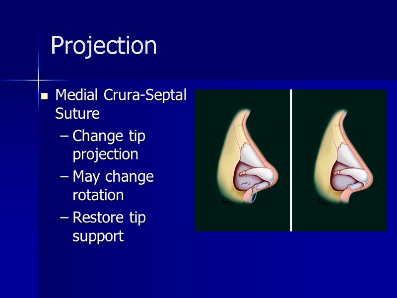 Projection Medial Crura-Septal Suture Change tip projection May change rotation Restore tip support